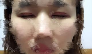 武汉双眼皮 武汉双眼皮